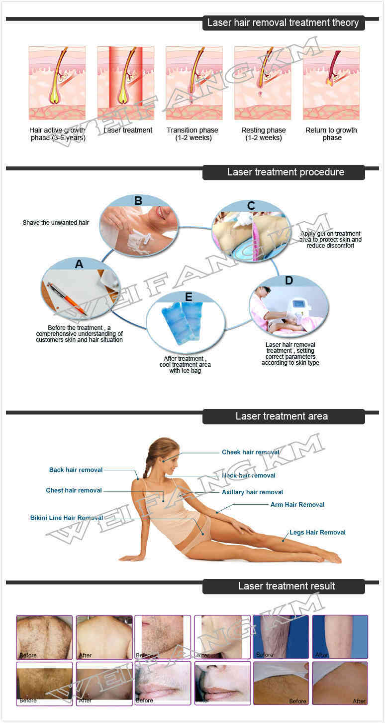 Italy Portugal Spain Laser Diode Painless Hair Removal Machine